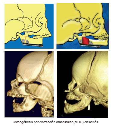 https://boxedfromabove.store/SiteCollectionImages/Infant_Mandibular_Distraction_Osteogenesis_es.jpg