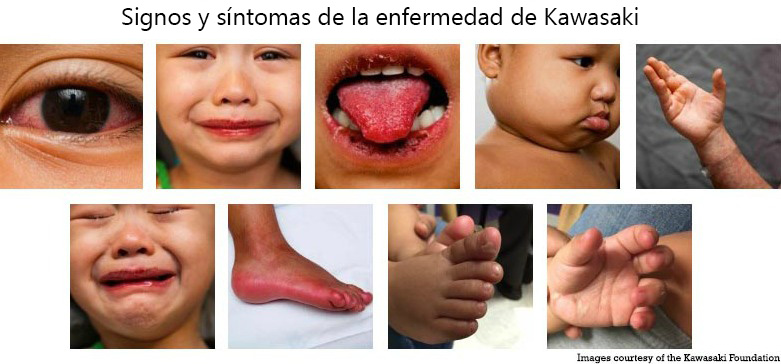 https://boxedfromabove.store/SiteCollectionImagesArticleImages/Signs_Symptoms_Kawasaki_Disease_es.jpg