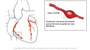 https://boxedfromabove.store/SiteCollectionImagesArticleImages/aneurysm_texaschildrens_es.jpg