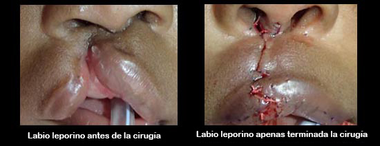 https://boxedfromabove.store/SiteCollectionImagesArticleImages/cleftLipBeforeAfter2_es.jpg